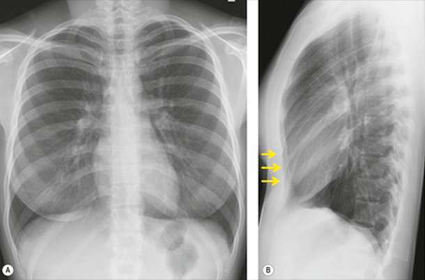 Chest X-Ray oblique view (right/left) , Preparation, Procedure, and the Requirements